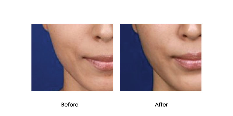 before-after-bellavita_0000_4