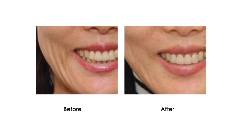 before-after-bellavita_0001_3