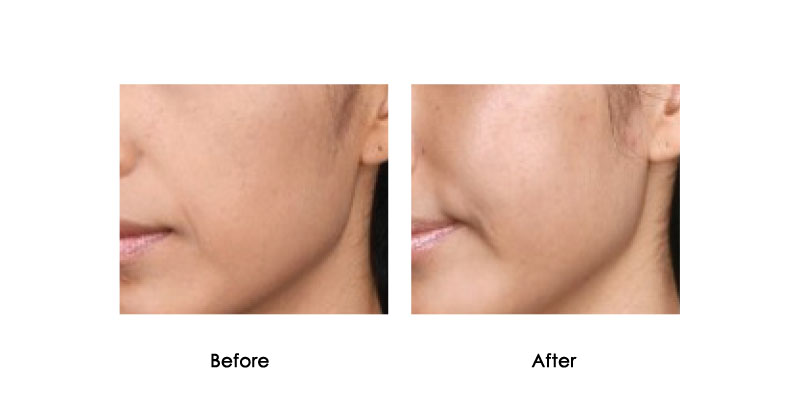 before-after-bellavita_0002_2