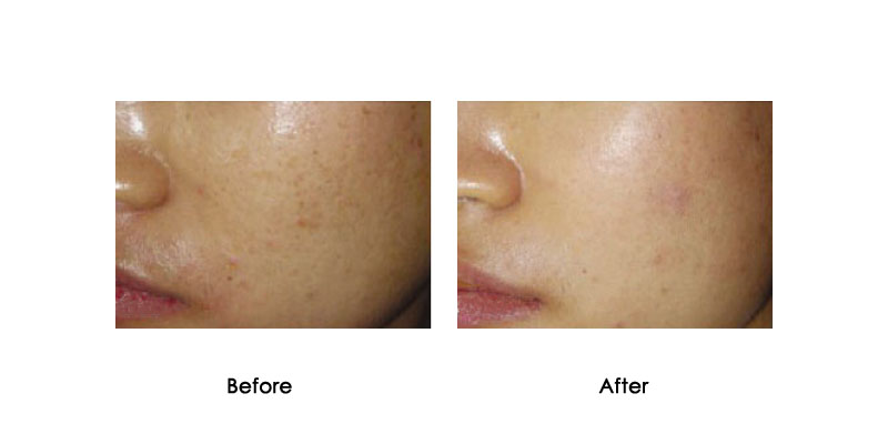 before-after-hydrafusion-pro_0000_6