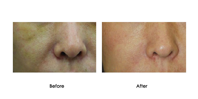 before-after-hydrafusion-pro_0005_1