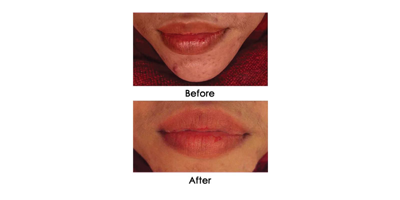 before-after-iris_0000_6