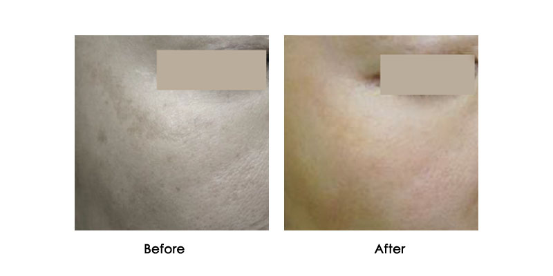 before-after-iris_0001_5