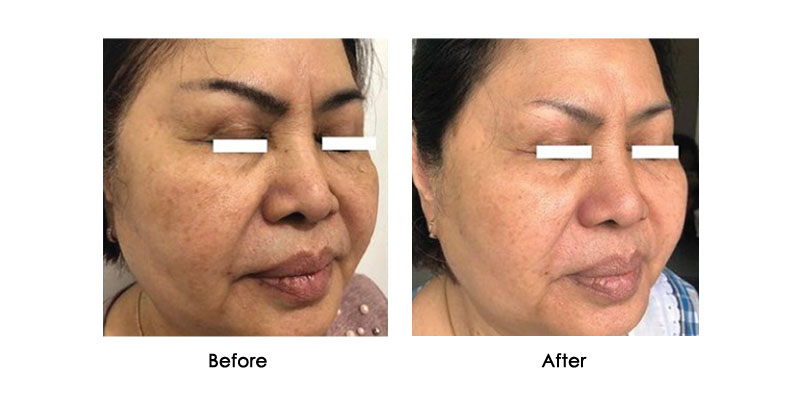 before-after-iris_0002_4