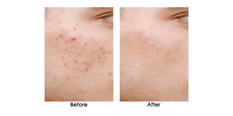 before-after-iris_0005_1