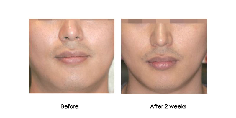 before-after-kabeline_0000_5