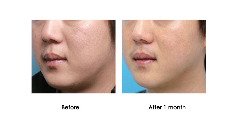 before-after-kabeline_0001_4