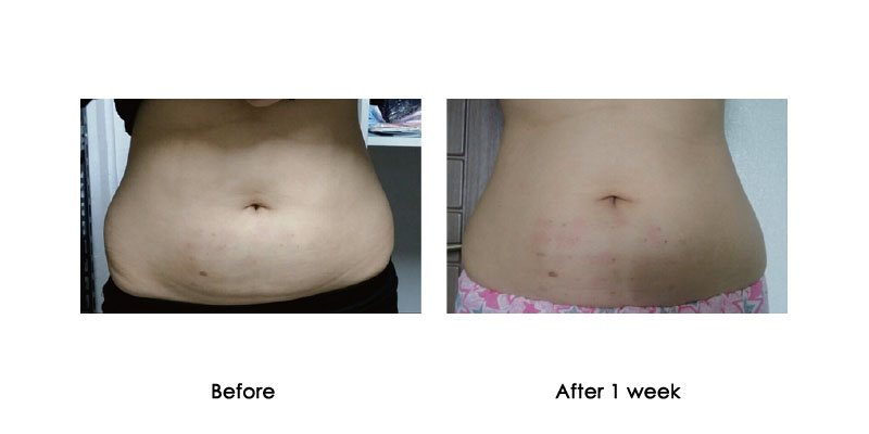 before-after-kabeline_0002_3