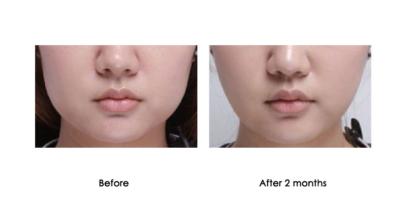 before-after-kabeline_0003_2