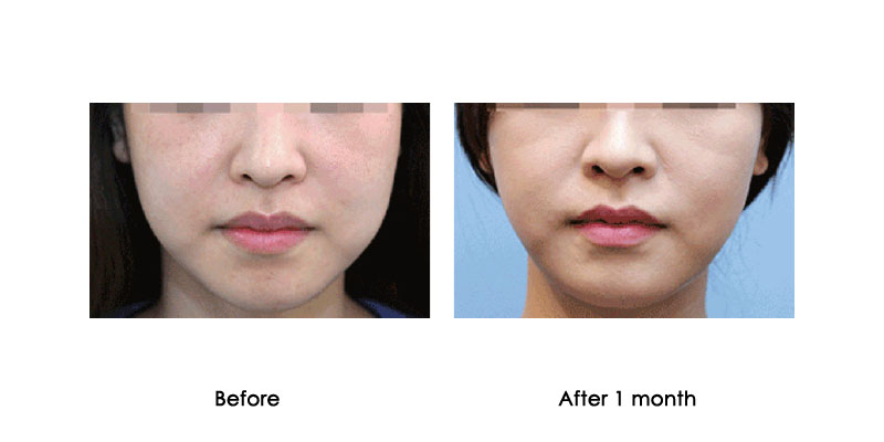 before-after-kabeline_0004_1