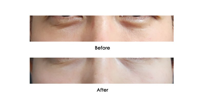 before-after-liftera-a_0000_4