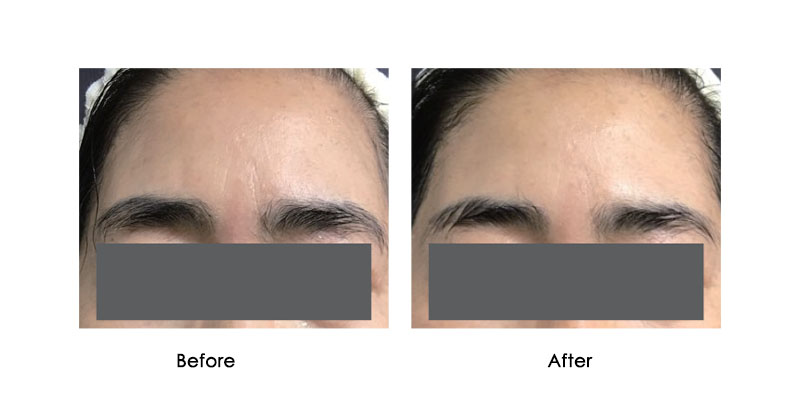 before-after-liftera-a_0002_2