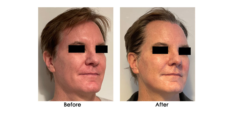 before-after-liftera-v_0002_2