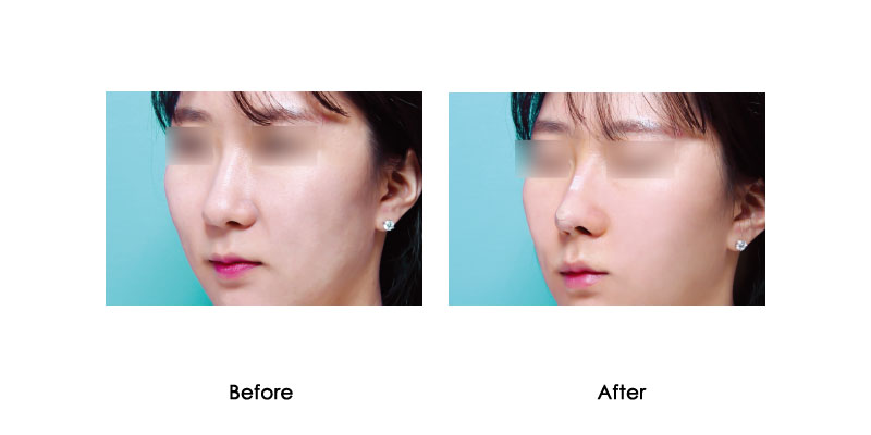 before-after-luluko_0001_3
