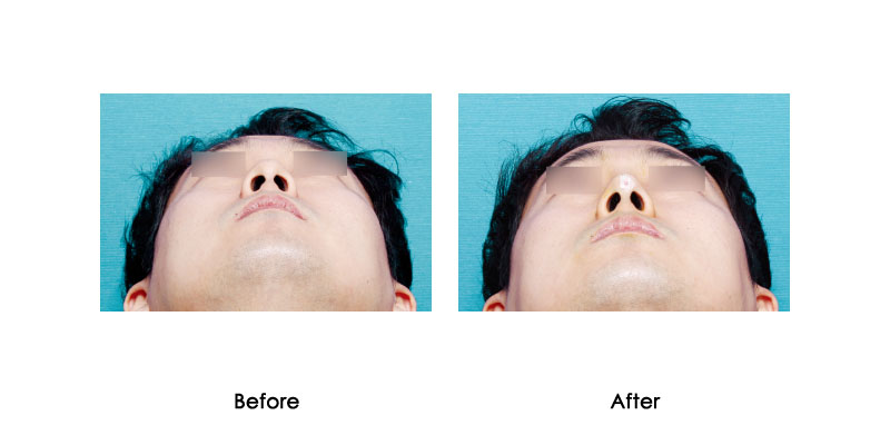 before-after-luluko_0003_1