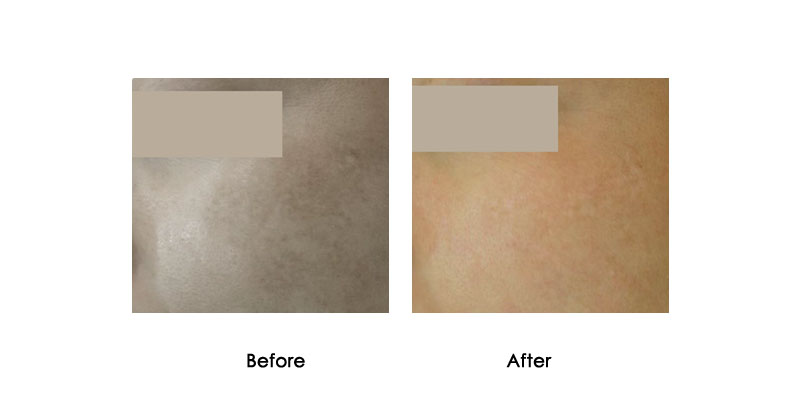 before-after-mevrik_0000_4