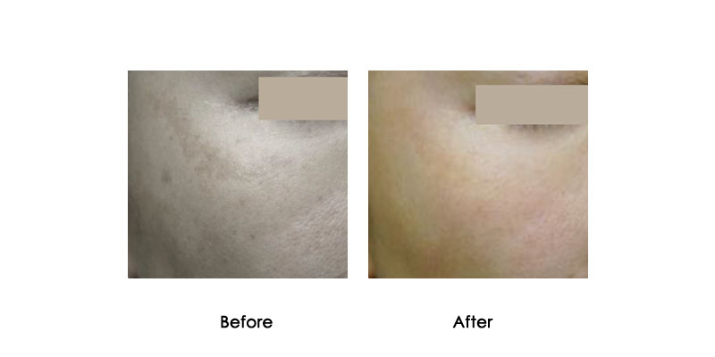 before-after-mevrik_0001_3