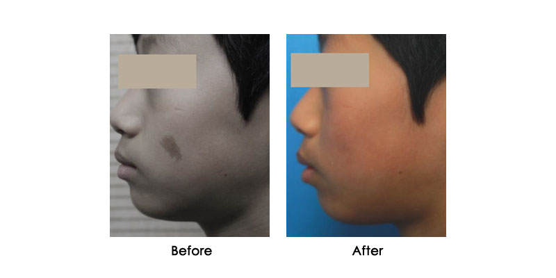 before-after-mevrik_0002_2
