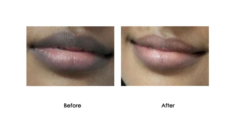 before-after-mevrik_0003_1