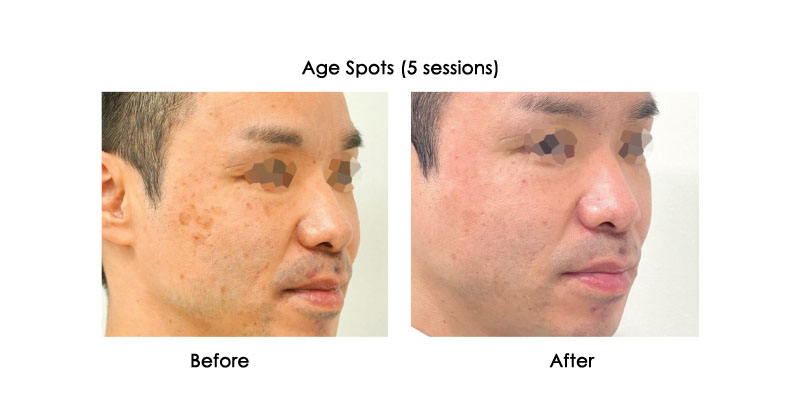 before-after-picore_0000_3