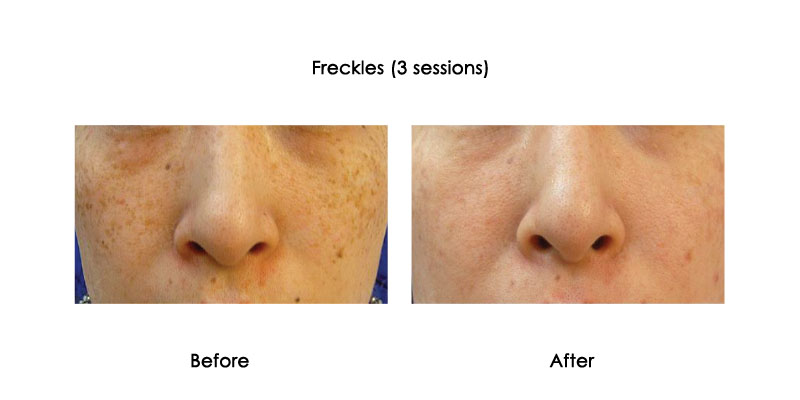 before-after-picore_0001_2