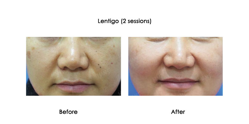 before-after-picore_0002_1