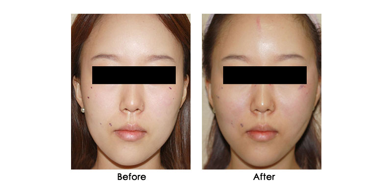 before-after-steigen_0000_3