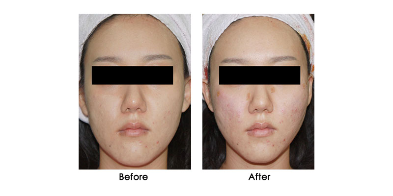 before-after-steigen_0001_2