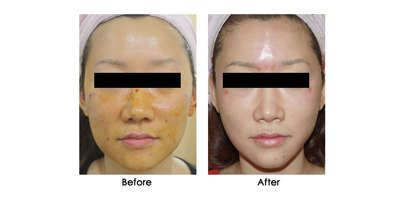 before-after-steigen_0002_1