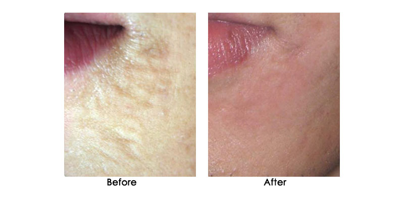 before-after-zenpro_0000_7