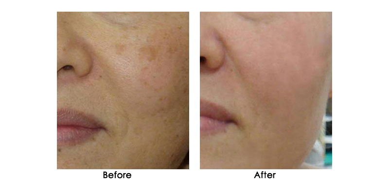 before-after-zenpro_0001_6