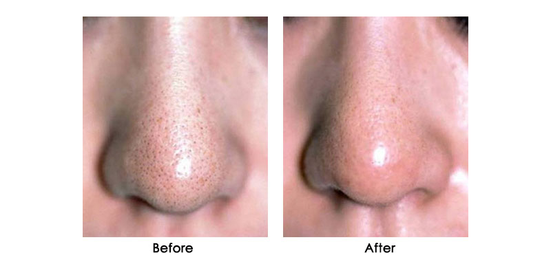 before-after-zenpro_0002_5