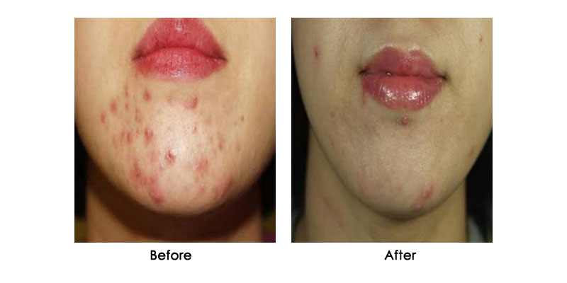 before-after-zenpro_0003_4