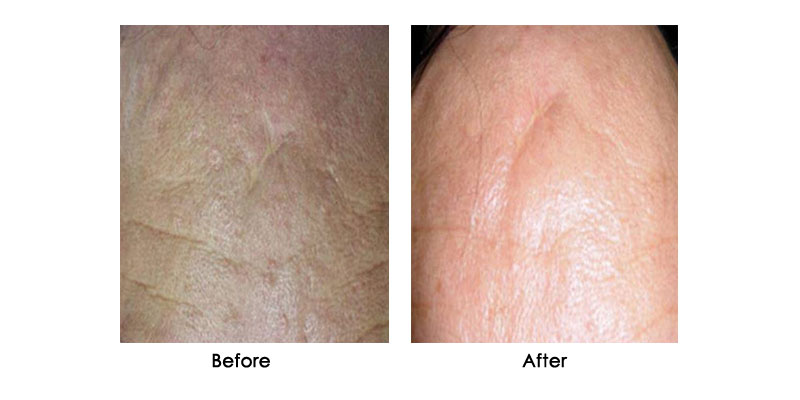 before-after-zenpro_0004_3