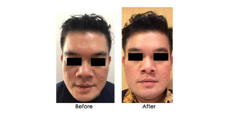 before-after-zenpro_0005_2