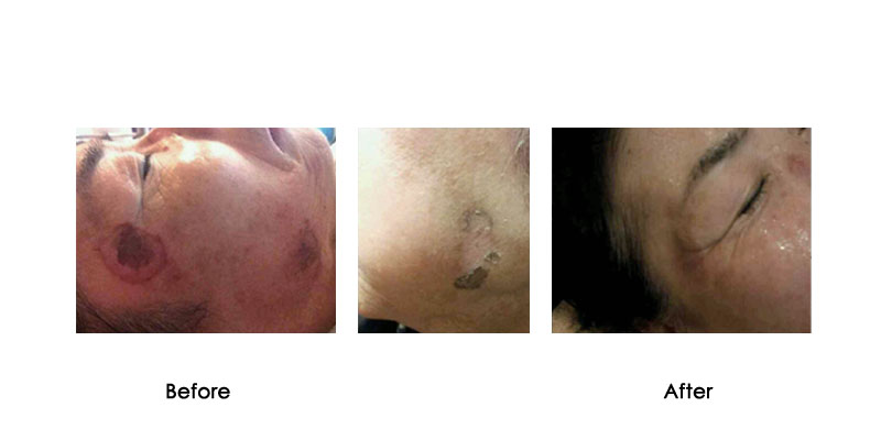 before-after-oxycryo_0000_6