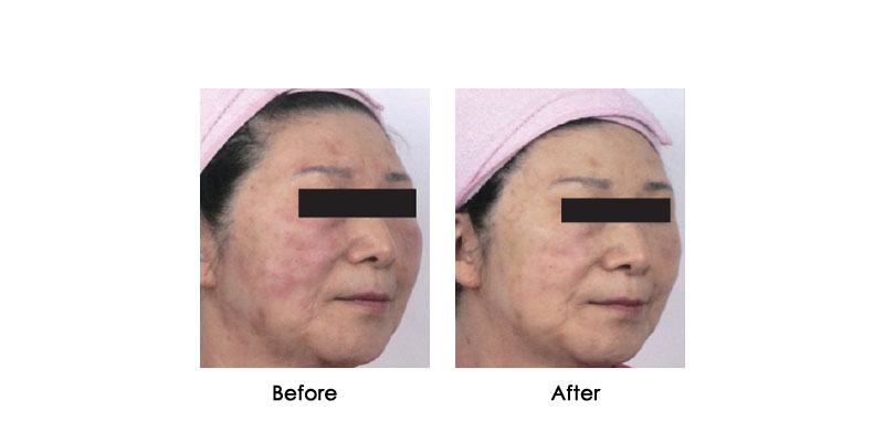 before-after-oxycryo_0001_5