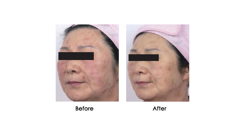 before-after-oxycryo_0002_4