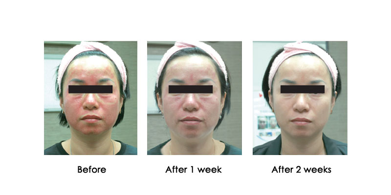 before-after-oxycryo_0003_3