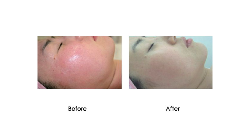 before-after-oxycryo_0004_2