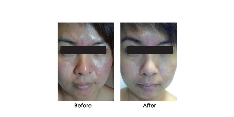 before-after-oxycryo_0005_1